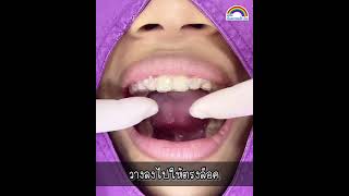 รีเทนเนอร์ใส เป็นยังไง | วิธีถอดใส่รีใสที่ถูกต้อง จะได้ใช้ได้นานๆ | How to wear clear retainer