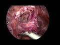 Laparoscopic paravaginal cystocele repair