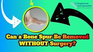 Can a Bone Spur on Feet Be Removed Without Surgery?