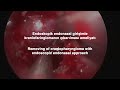 Endoscopic Endonasal Craniopharyngioma Removal Surgery