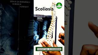 #scoliosis  Explaining Scoliosis by MRI-முதுகு தண்டுவட அமைப்பில் ஏற்படும் மாற்றம் #shorts #facts