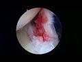 r shoulder capsular release for frozen shoulder 9 15 22 ap