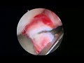 r shoulder capsular release for frozen shoulder 9 15 22 ap