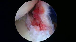 R Shoulder Capsular Release for frozen shoulder 9 15 22 AP