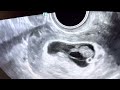 take a peek ultrasound of a triple sac pregnancy at 8 weeks continuing as twins