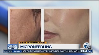 Microneedling helps firm skin and reduce wrinkles