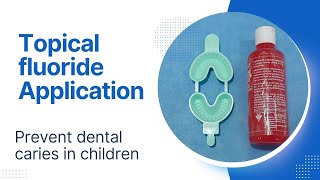 Topical Fluoride application in children