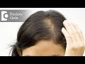 Causes of hair loss - Dr. Vivekanand Bhat