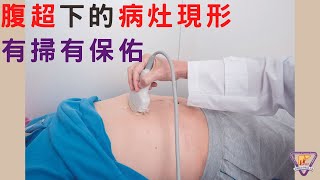 腹超下的病灶現形 有掃有保佑｜好心肝˙好健康