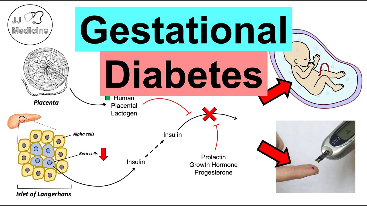 Gestational Diabetes Pregnancy Diabetes Causes Risk Factors
