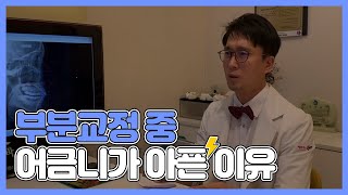 [Q\u0026A] 해운대교정치과, 부분교정 중 어금니가 아픈 이유!