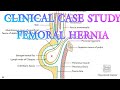 #femoralherniaCaseStudy #vishramsingh