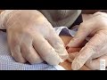 infected cyst removal on the mid back inp