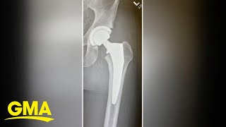 A look at hip replacements in younger adults | GMA