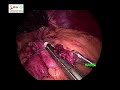 laparoscopic gastric bypass