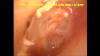 中耳炎全內視鏡手術後 癒合期  COM post TEES ear canal skin defect 劉耿僚醫師