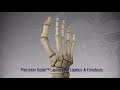 Lapidus Arthrodesis using Gorilla Recon Lapidus Plating System from Paragon28