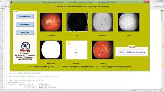 Diabetic Retinopathy Identification Using Matlab Code | Image Processing Project With Source Code