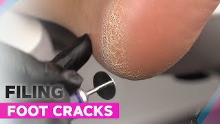 Foot Cracks Removal | E-file Pedicure