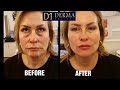 derma lift