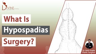 Dr. Amit Gupta Explained About Hypospadias | Types, Causes, Symptoms, & Treatment