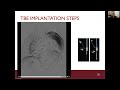 Total Endovascular Treatment Options for Aortic Arch Pathologies