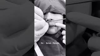 Subnasal Lip Lift Surgery: Enhance Your Lips with Dr. Arun Panda