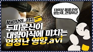 의느님답변📂후두부도,수염도 더이상 채취할 곳이 없다?! 비장의 카드가 있습니다💳ㅣ다나성형외과(DANA)ㅣ모발이식ㅣ헤어라인교정ㅣ두피문신ㅣ탈모치료ㅣ대량모발이식