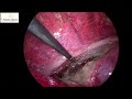 management of esophageal perforation with acute mediastinit