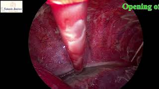 Management of esophageal perforation with acute mediastinit