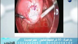 #الطبيب: د. عمرو الحسيني: انواع الاورام الليفية في الرحم، وتأثيرها على الخصوبة