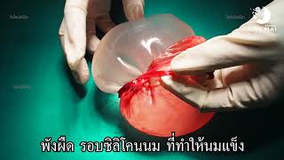 เสริมหน้าอก 13 :พังผืดรอบซิลิโคนนม  capsular contracture