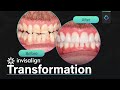 LIFE CHANGING Teeth Restoration! Impossible Transformation Solved with Invisalign Ep3