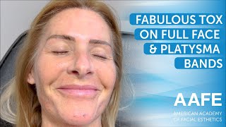 Fabulous Tox on  Face & Platysma Bands