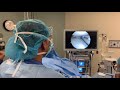 Fully Awake Knee Arthroscopy by Dr Mora