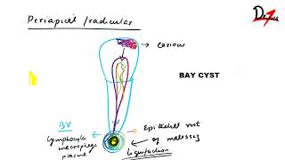 Radicular cyst : PATHOGENESIS, CF, RF \u0026 TREATMENT