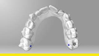 Invisalign - nagyon fejlett fogszabályozó rendszer | Jókai Dental fogorvos Budapesten