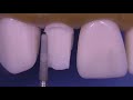 pfm preparation on tooth 7 kilgore stevenson dental solutions