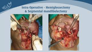 Salivary gland tumor- floor of mouth | Dr Bhushan kathuria | ENT | Head \u0026 Neck Oncosurgeon