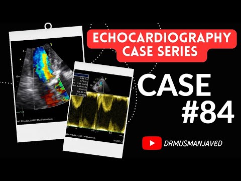 Echo Case 84 Echocardiography Case Series Echocardiogram