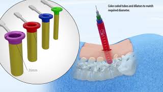 Phantom ML MIS Surgical Tubes Access System