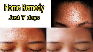 நெற்றியில் உள்ள பருக்கள் மறைய | Forehead Pimples removal  at home remedies