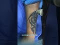 eliminación de tatuajes con láser dr. angélica domínguez dermatóloga en bogotá