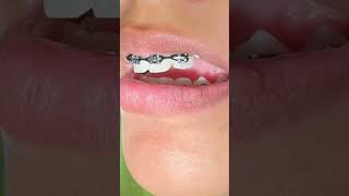 Impacted Canine 24 months Braces Timeline - Orthodontic Traction - Tooth Time Family Dentistry