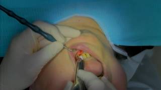 EXTRACTIONS MULTIPLES ET ANESTHESIE OSTEO CENTRALE