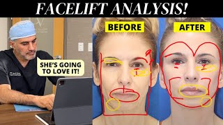 Facial Plastic Surgeon Analyzes his 63 year old patient's face!