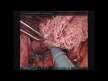 dmh robotic redo hiatal hernia repair with nissen fundoplication