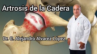 Artrosis de la cadera