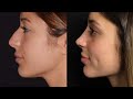 before and after results and a patients testemonial of her designer rhinoplasty tm