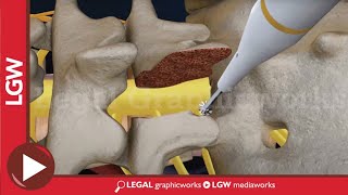 L5-S1 Lumbar Discectomy and Fusion Surgery 3D animation